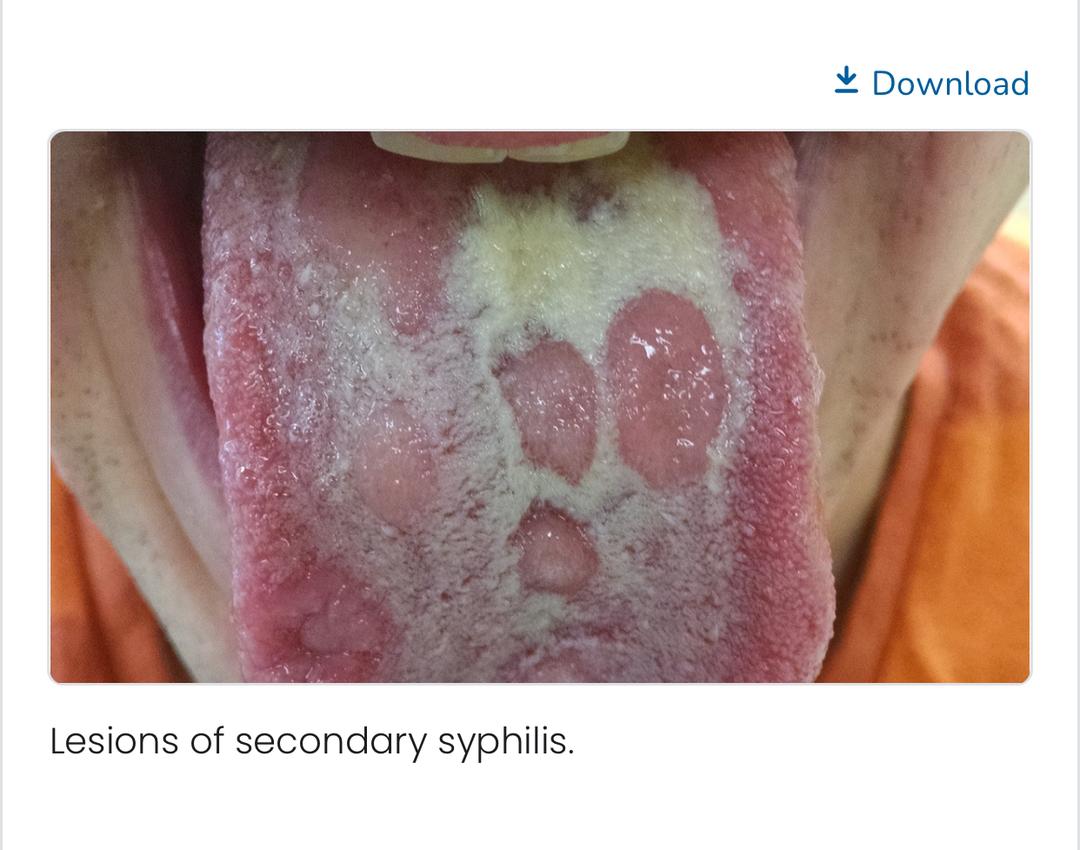 Person recovered from fever